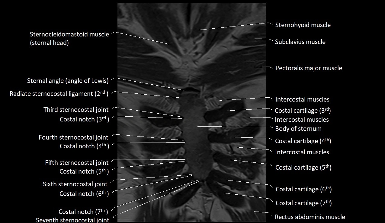 MRI sternum and sternoclavicular joint labeled coronal anatomy image 7.webp